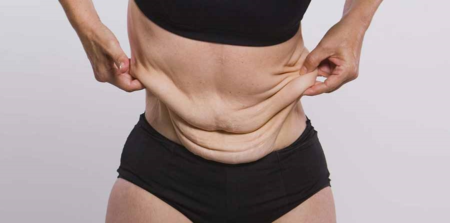 عوامل تاثیرگذار در افتادگی پوست پس از تقلیل وزن