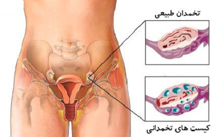 چگونه می‌توان از کیست تخمدان پیشگیری کرد؟