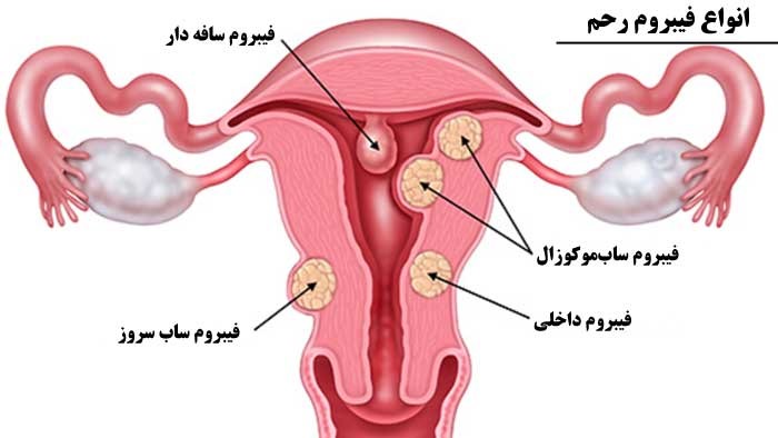 لاپاراسکوپی فیبروم