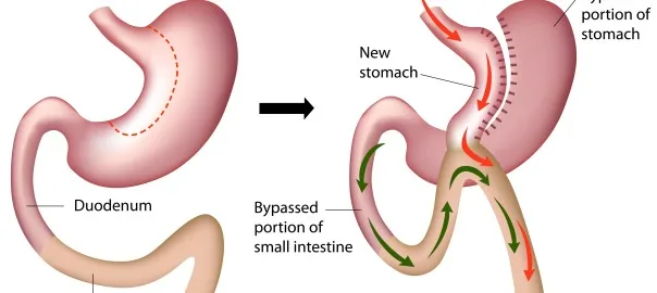 تصویر آرشیوی مقاله مینیبایپس یا بایپس کلاسیک؛ چه چیزهایی را مقایسه کنیم؟