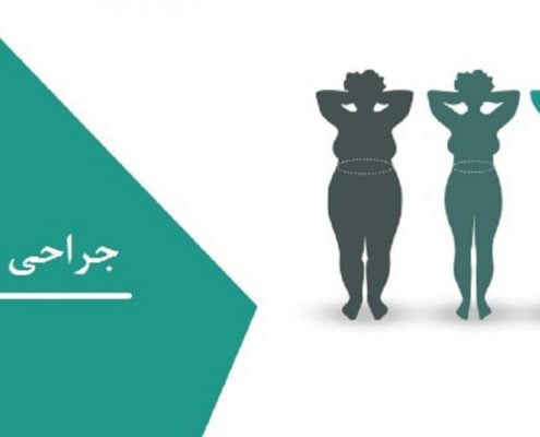 هزینه جراحی چاقی