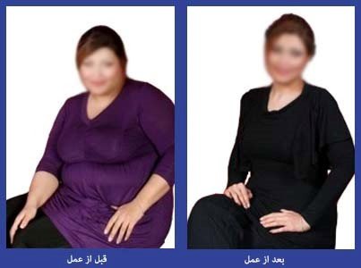 مزایای ابدومینوپلاستی کدامند؟