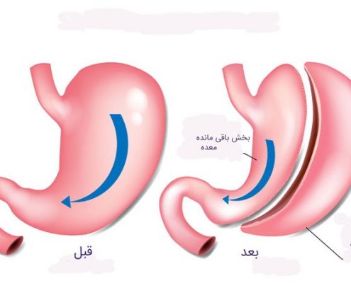 جراحی اسلیو معده چگونه عملی است؟