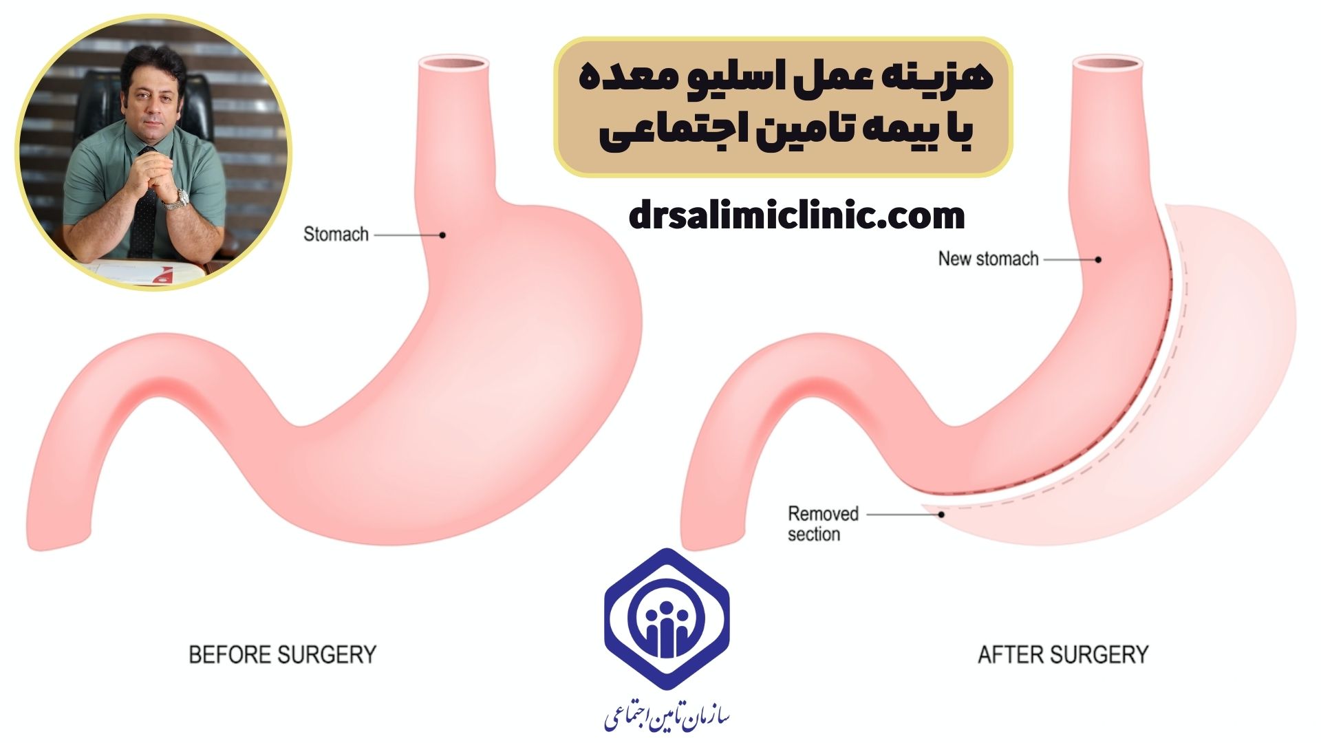 هزینه عمل اسلیو معده با بیمه تامین اجتماعی