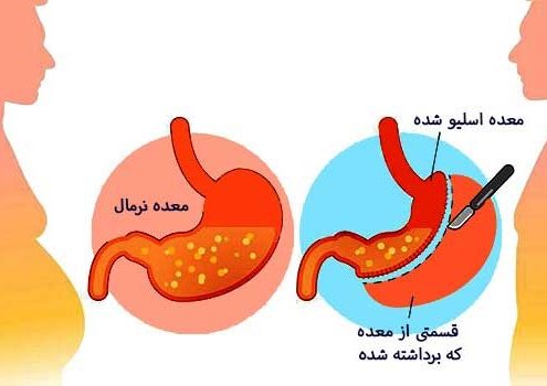 دوره ی نقاهتی که برای اسلیو معده وجود دارد شامل چه مواردی است؟