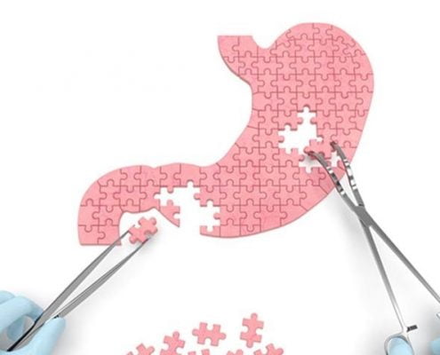 تعداد فاز ها و مراحل عمل جراحی و مقدار کاهش وزن در عمل اسلیو معده: