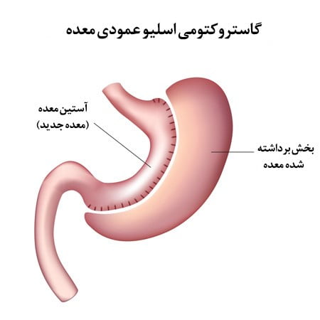 عمل اسلیو معده برای چه کسانی موفقیت آمیز است؟