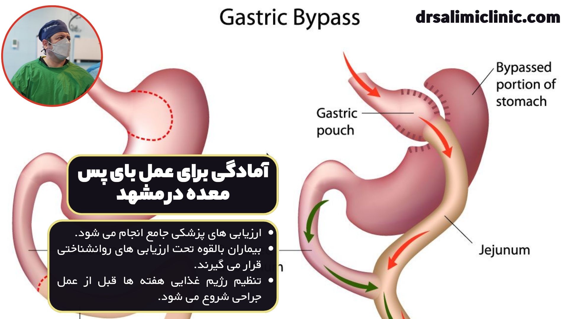 آمادگی برای عمل بای پس معده در مشهد