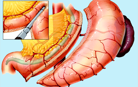 چه تجربیات آزار دهنده ای در عمل اسلیو تجربه شده است؟