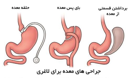 عمل اسلیو معده سبب کاهش میل جنسی می شود؟