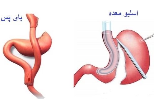 عمل بای پس معده چه تفاوتی با عمل اسلیو معده دارد؟