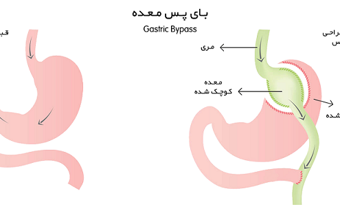 چاقی باعث بروز چه بیماری هایی می شود؟