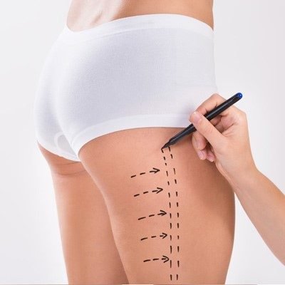در چه شرایطی بیمه هزینه عمل های جراحی لاغری را متقبل خواهد شد؟
