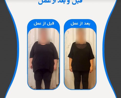 انجام عمل اسلیو معده چه مزیت هایی دارد؟