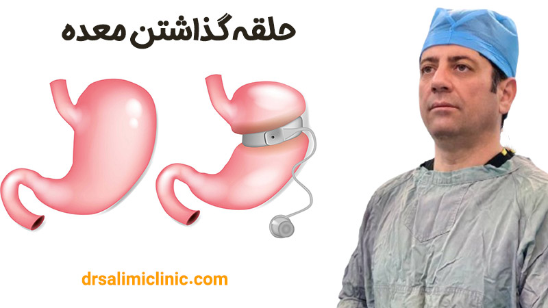 حلقه گذاشتن معده - drsalimiclinic.com