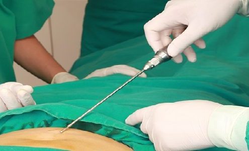 عمل جراحی لیپو پلاستی