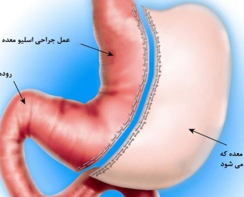 پس از عمل جراحی اسلیو معده افراد چه نتیجه‌ای را مشاهده می کنند و کسانی که این عمل را انجام دادند در رابطه با آثار عمل اسلیو معده چه نظری دارند؟