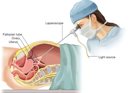 کاربرد لاپاراسکوپ در تشخیص و خارج نمودن تومورها و غدد خاص