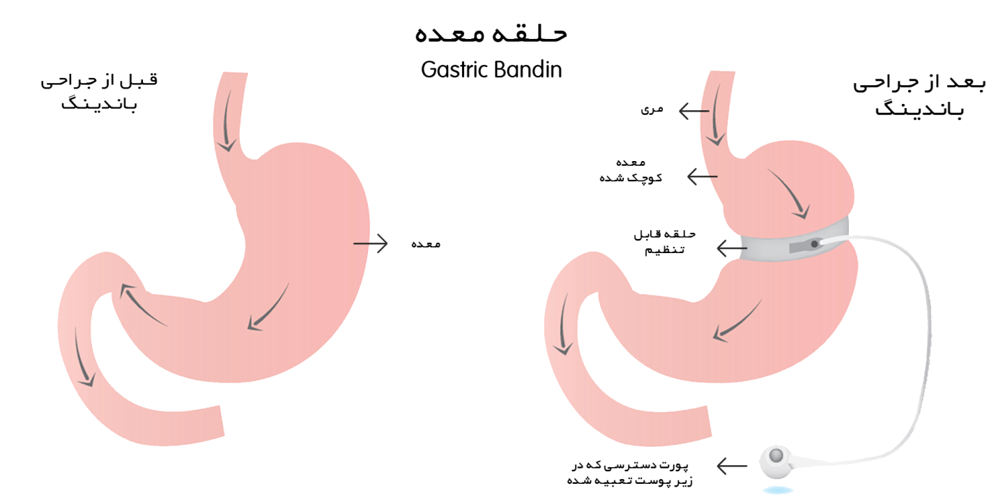 حلقه معده مشهد