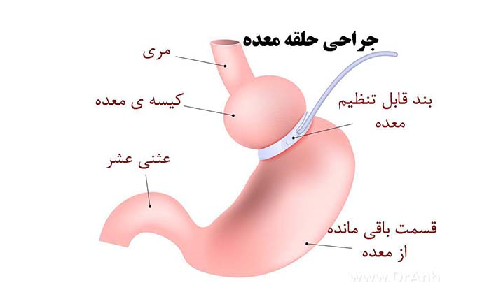 عمل پلیکاسیون یا پلیسه معده