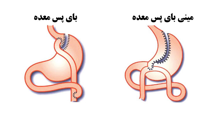 برخی مزایای عمل جراحی اسلیو معده: