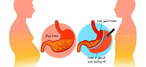 خلاصه مقاله 30 کیلو کاهش وزن در 2 ماه