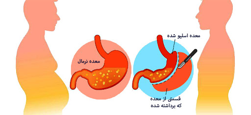 استفاده از جراحی اسلیو معده نمی ‌تواند شی‌ء خارجی را در داخل بدن تعبیه کند