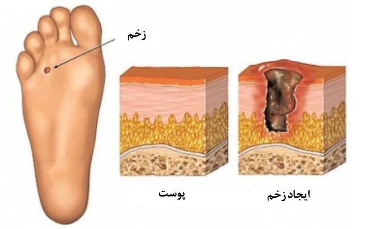 آیا در خصوص پیشگیری از ایجاد زخم های پای دیابتی اطلاعاتی دارید؟