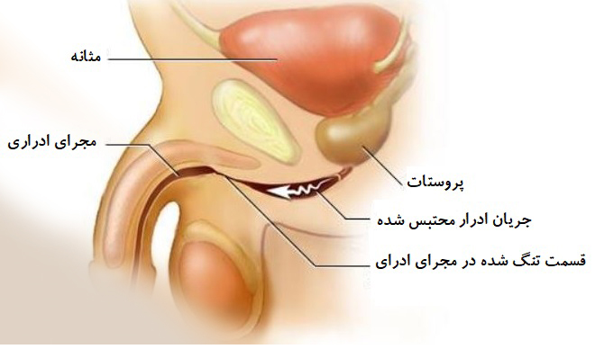 موارد زیر نیز می ‌تواند سبب بالا رفتن میزان اوره در آزمایش خون نیتروژن اوره شوند: