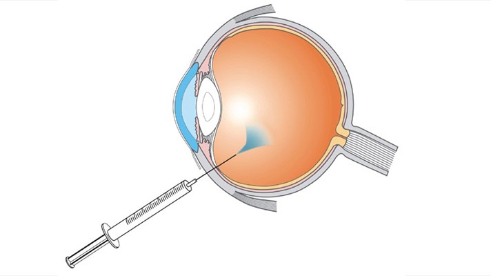 آیا با مقهوم تزریق در داخل چشم آشنایی دارید؟ آیا می دانید در این اقدام چه اتفاقی می افتد؟
