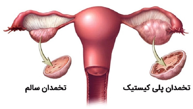 ارتباط چاقی و سندرم پلی کیستیک تخمدان