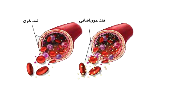 اگر هیچ‌گونه درمانی برای دیابت ملیتوس نوع اول صورت نگیرد، چه اتفاقاتی در پیش خواهد بود؟