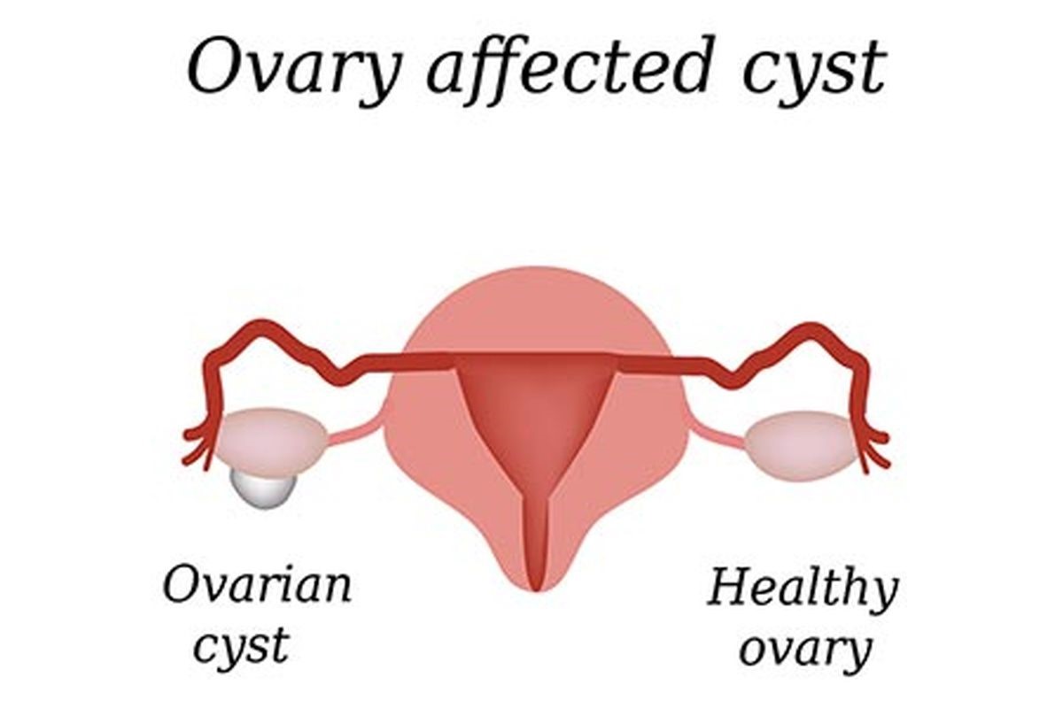 Cystectomy تخمدان از طریق Laparotomy: