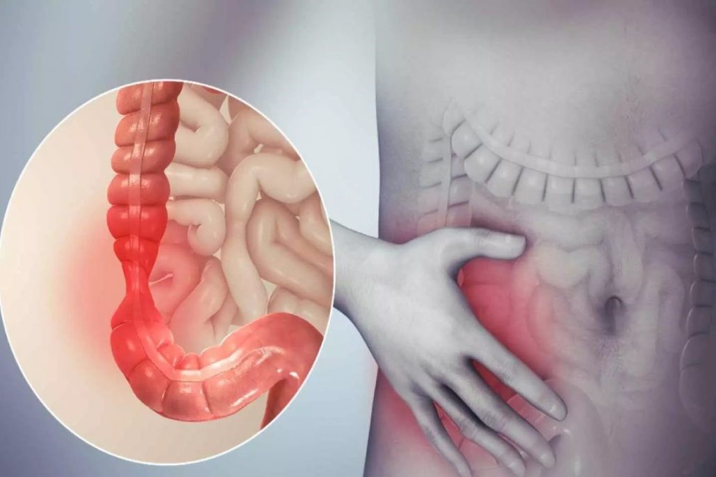 علائم بیماری سندروم روده تحریک پذیر