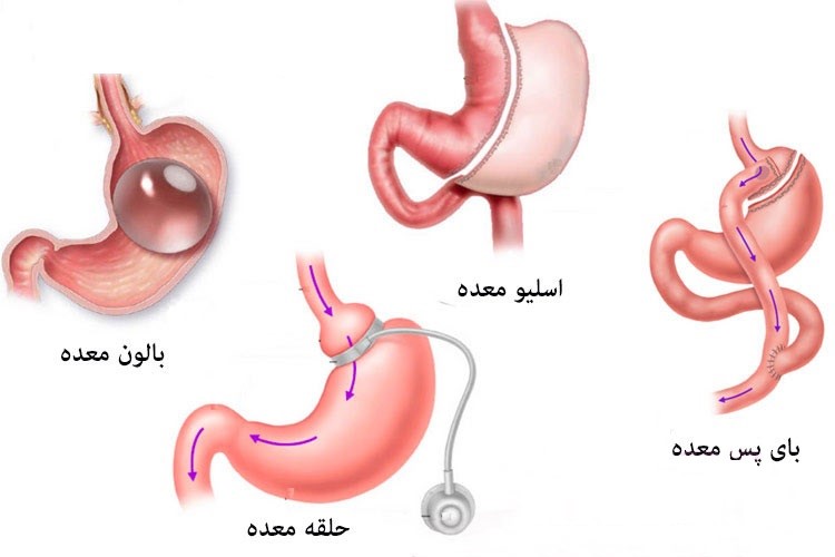 آشنایی و معرفی انواع گوناگون جراحی‌های لاغری: