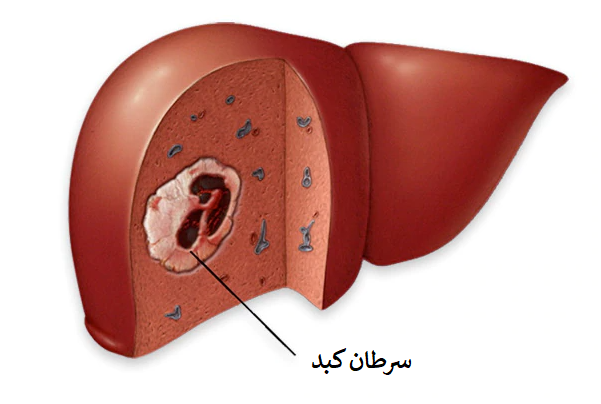 سرطان کبد