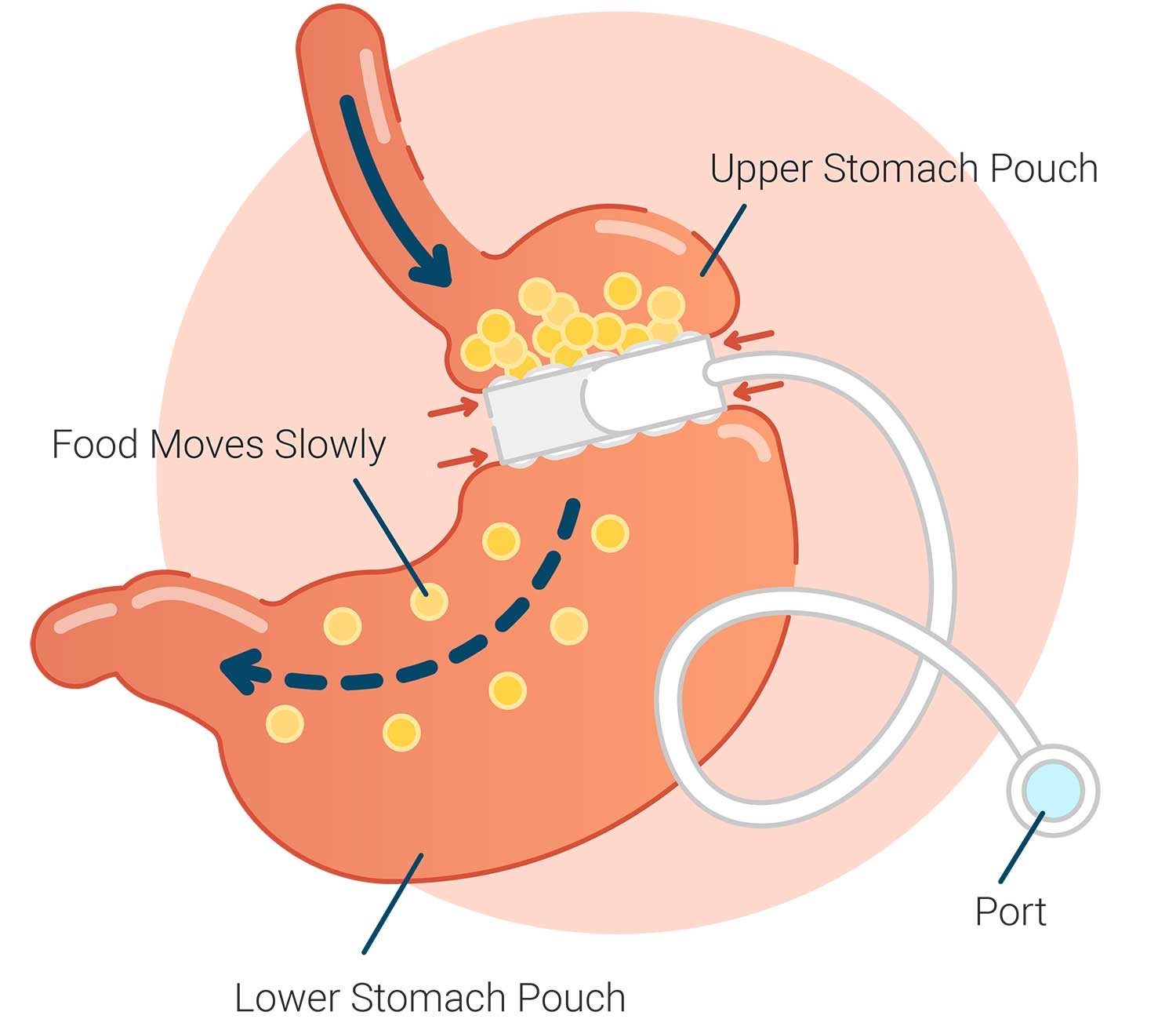 برنامه غذایی پس از Gastric Balloon