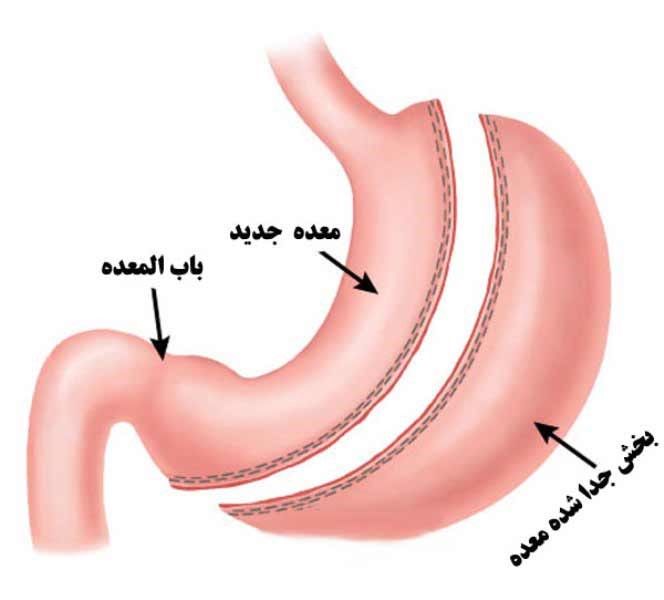 جراحی چاقی به روش بای پس معده