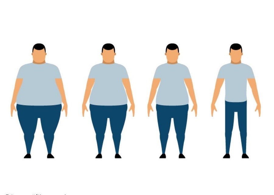 جراحی چاقی بهترین راه درمان BMI بالا