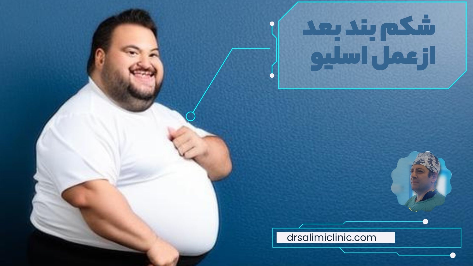 شکم بند بعد از عمل اسلیو