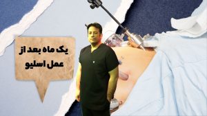 یک ماه بعد از عمل اسلیو