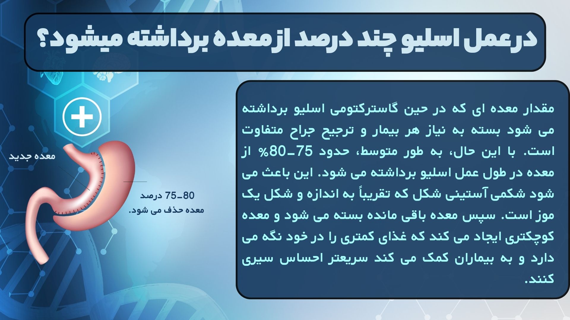چند درصد از معده در عمل اسلیو برداشته می شود؟