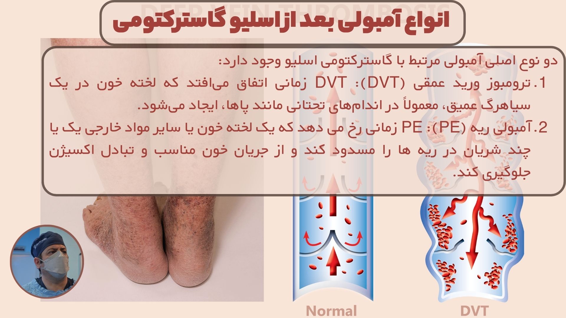 انواع آمبولی بعد از اسلیو گاسترکتومی