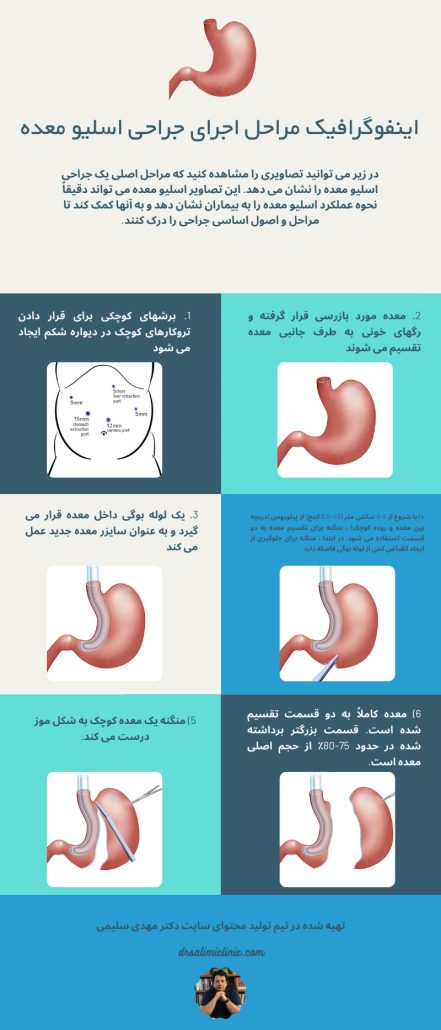 مراحل انجام عمل جراحی اسلیو معده