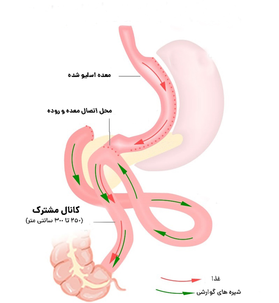 مراحل عمل ساسی بای پس معده