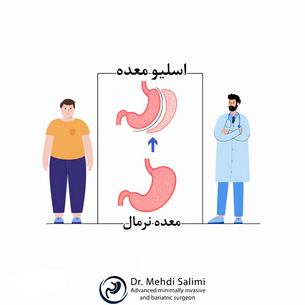 معرفی بهترین پزشک برای عمل اسلیو معده