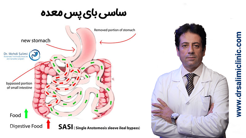 عمل ساسی بای پس معده