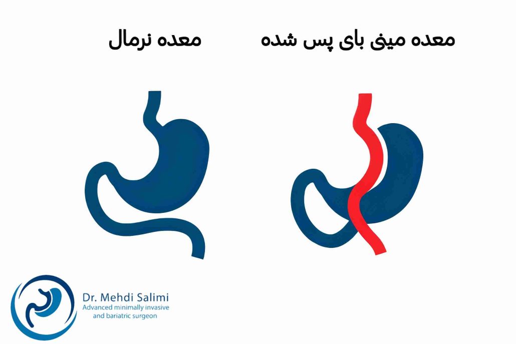 مزیت های عمل مینی بای پس معده