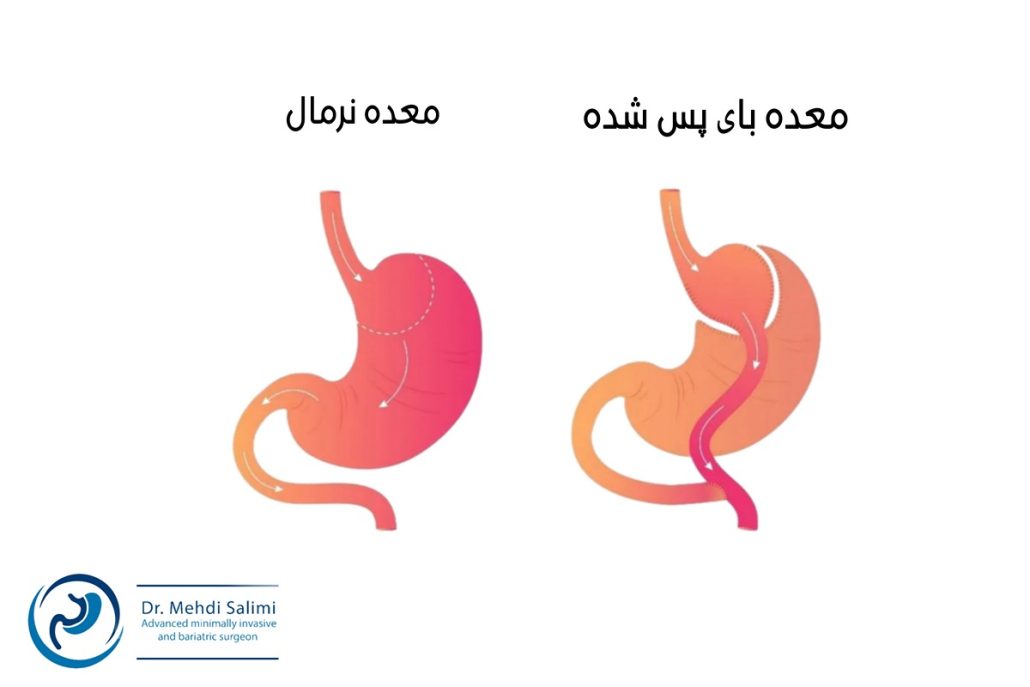 معده بعد از عمل بای پس