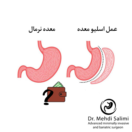 هزینه اسلیو معده در تهران